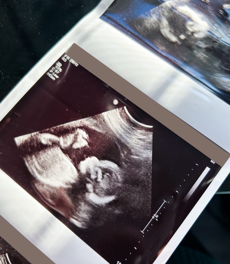 creative ultrasound photo ideas